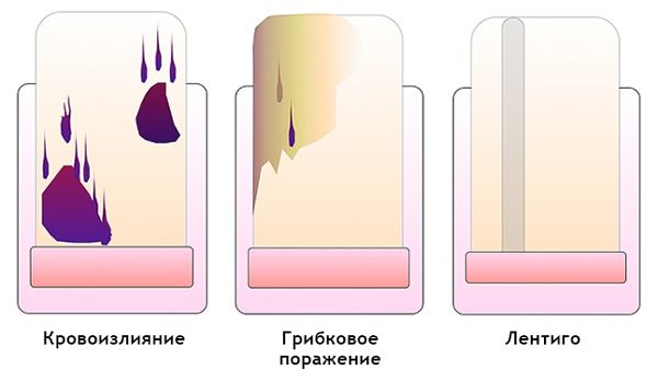 Как отличить гематому от подногтевой меланомы при дерматоскопии