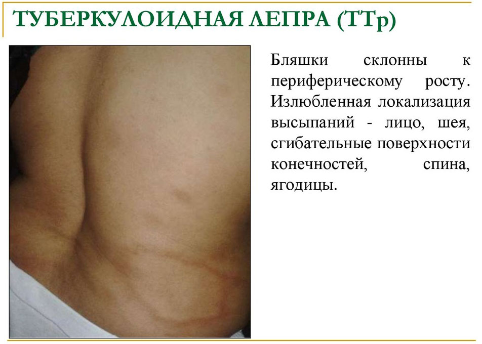 Туберкулоидная форма проказы Туберкулоидная форма проказы