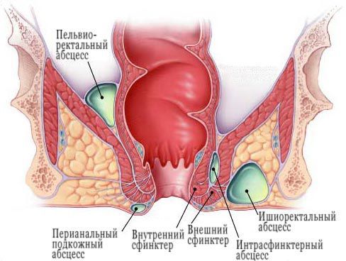 Классификация аноректальных абсцессов