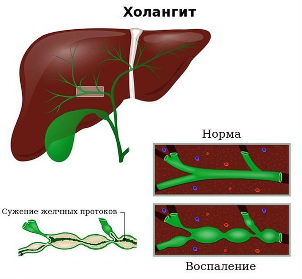 Холангит Холангит