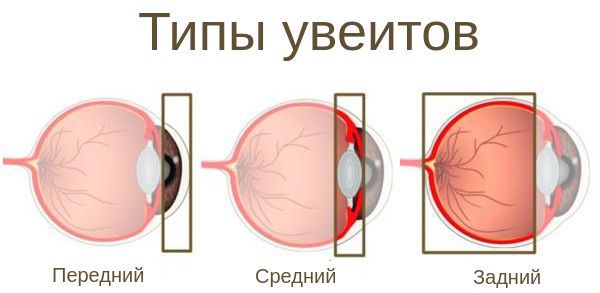 Виды увеита