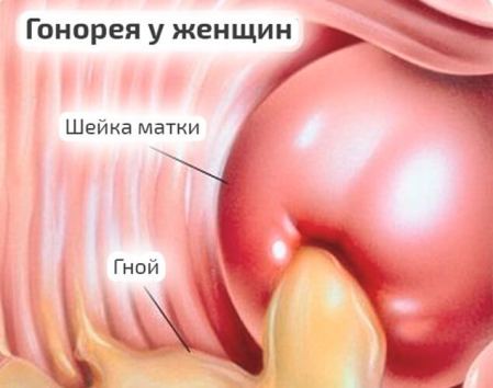 Гонорея у женщин и мужчин: «французский насморк» хуже, чем кажется