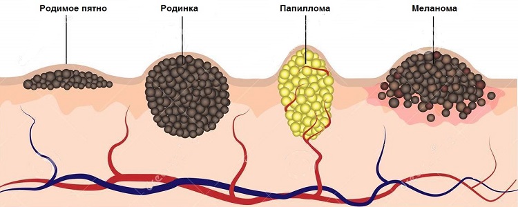 Варианты проявления ПВИ на коже