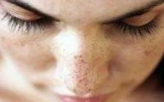 разноцветный лишай разноцветный лишай
