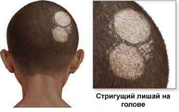 стригущий лишай на голове