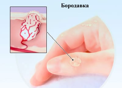 Бородавки