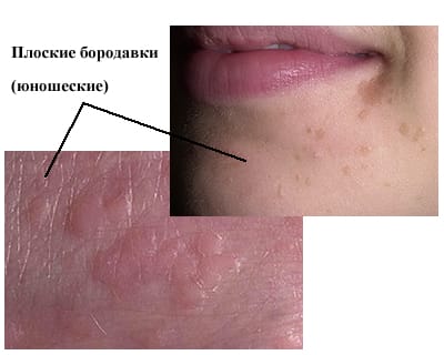 плоские бородавки