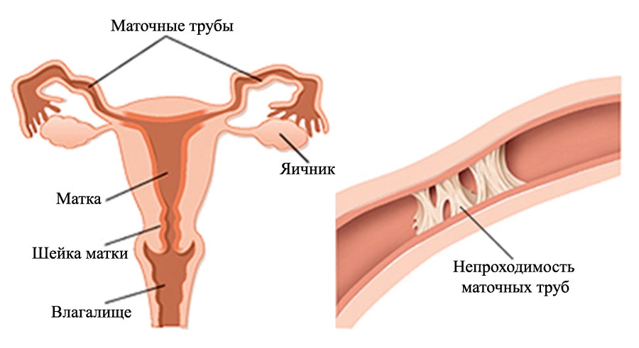 закупорка труб трубное бесплодие - следствие гонореи