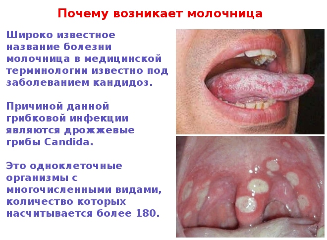 Фото, почему возникает молочница