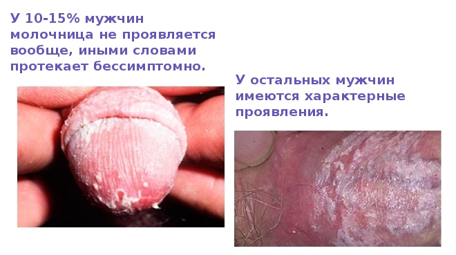 Фото, как проявляется молочница