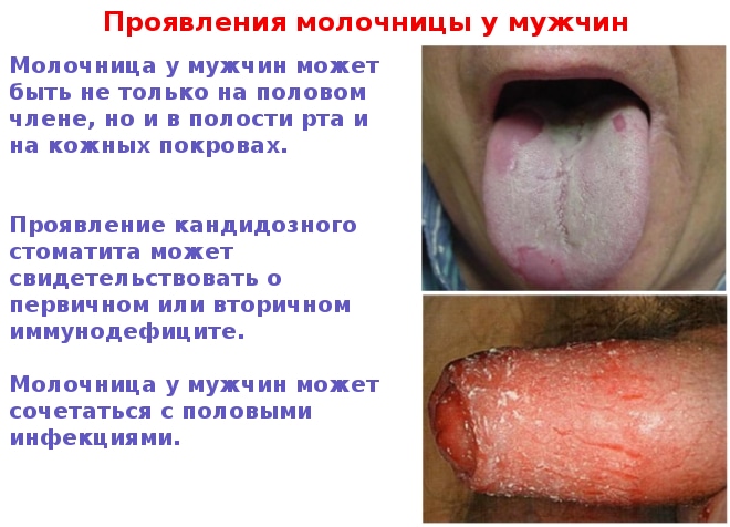 Фото симптомов молочницы у мужчин