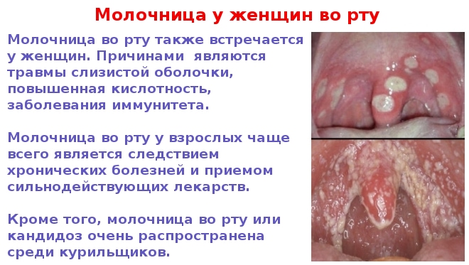 Фото с причинами молочницы у женщин
