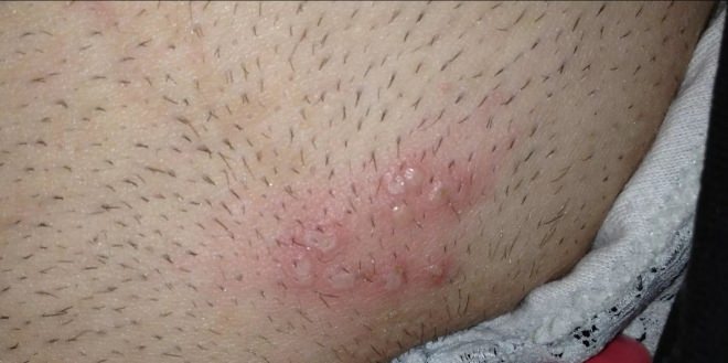 Фото, как выглядит сыпь при генитальном герпесе