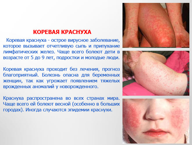 Корь краснуха фото