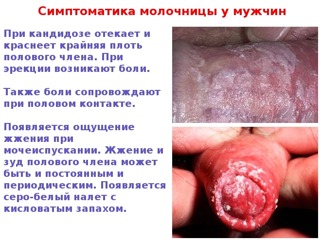 Картинки с признаками молочницы у мужчин