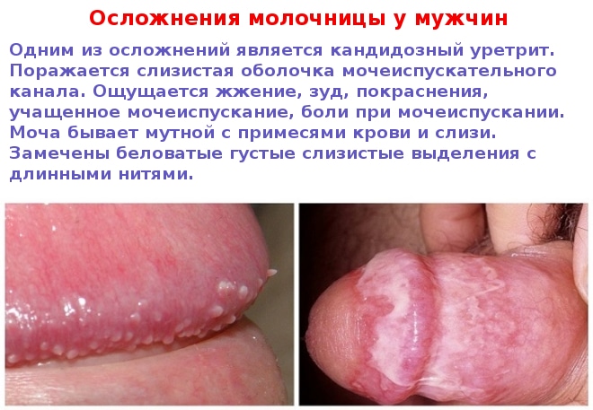 Осложнения молочницы у мужчин фото