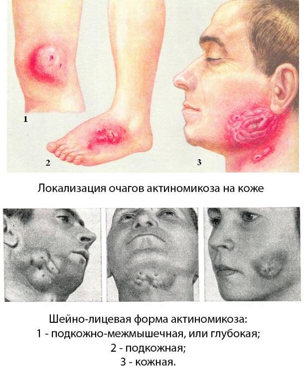 Кожный актиномикоз