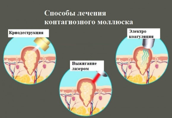 Моллюски на коже ребенка. Фото, причины и методы лечения, как избавиться