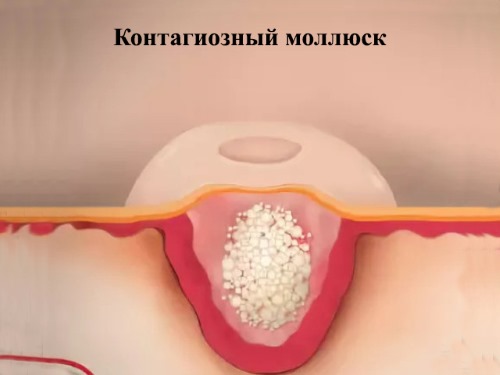 Моллюски на коже ребенка. Фото, причины и методы лечения, как избавиться